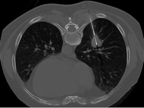 Cureus | Complications and Risk Factors of Patients Undergoing Computed Tomography-Guided Core ...