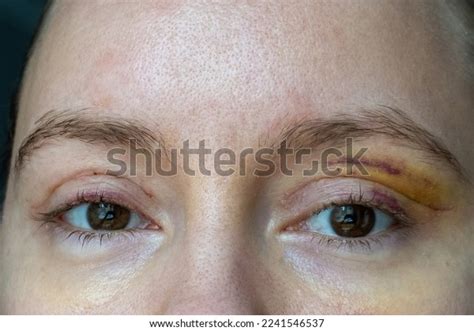 Woman Face Recovery After Plastic Surgery Stock Photo 2241546537 ...