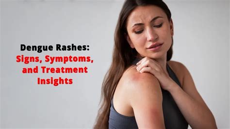 Understanding Dengue Rashes: Signs, Symptoms, and Treatment Insights ...