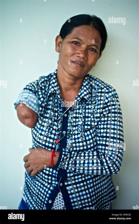 Model released portrait of a Cambodian land mine survivor, who lost an ...