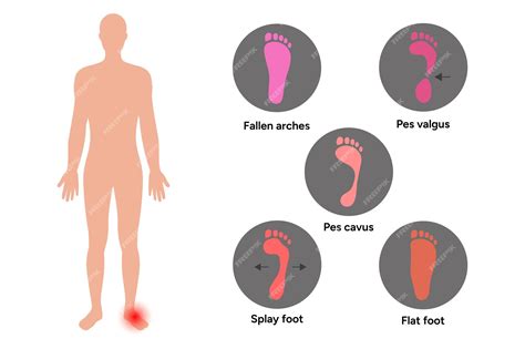 Premium Vector | Types of deformity foot fallen foot flat foot pes valgus pes cavus splay foot