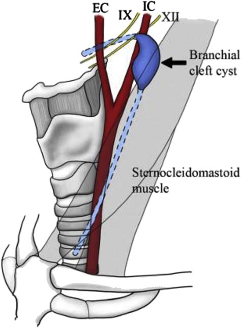 Pediatric Branchial Cleft Cysts: A Case Study - Journal of Pediatric Health Care