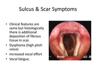 Sulcus vocalis | PPT