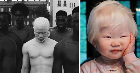 Unique Beauty Of Albino People