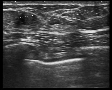 Ultrasound of fluid level is seen in cystic lesion which is... | Download Scientific Diagram