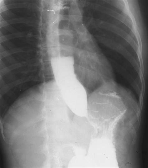 Achalasia Cardia-Barium Swallow - Sumer's Radiology Blog