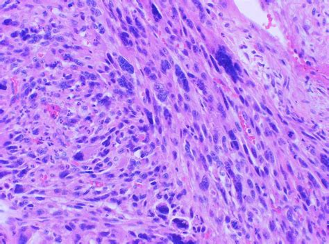 Malignant Fibrous Histiocytoma (MFH): Undifferentiated Pleomorphic Sarcoma (UPS): Soft Tissue ...