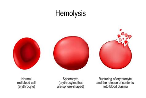 Causes of High and Low Hemoglobin Levels - Health & Detox & Vitamins