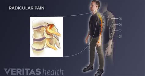 Radiculopathy, Radiculitis and Radicular Pain