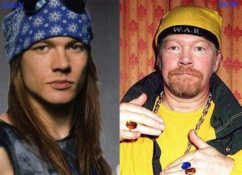 Axl Rose Plastic Surgery Photo Before and After | Plastic surgery photos, Face plastic surgery ...