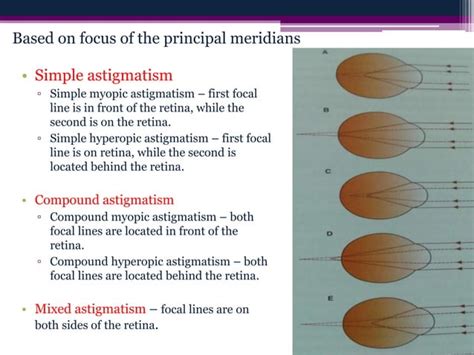 Optics of ametropia | PPT