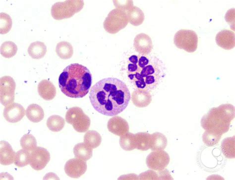 Hypersegmented Neutrophil - 2.