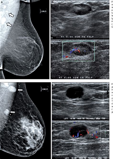 Figure 1 from Abnormal axillary lymph nodes on negative mammograms: causes other than breast ...