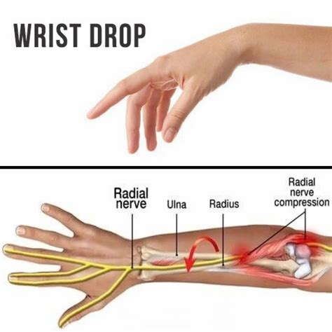 What is Radial Nerve Palsy?