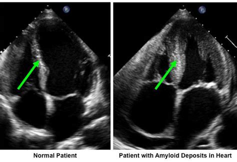 Amyloidosis | Stanford Health Care