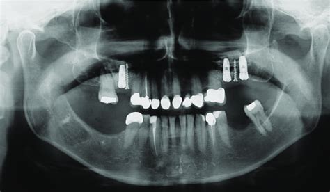 Ramus graft fixation in bilateral sinus lift procedure using bicortical ...