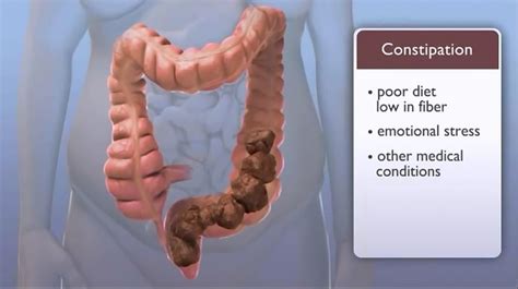 My Family Medicine Practice: Chronic Constipation - Causes , Signs ...