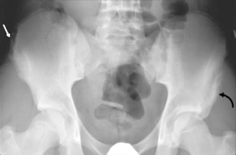 Iliac crest avulsion injury. AP view of the pelvis shows asymmetric... | Download Scientific Diagram