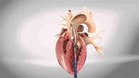 Undertsanding A Transcatheter Aortic Valve Replacement (TAVR) - Central ...