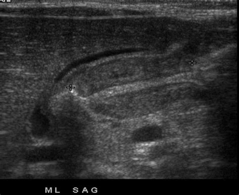 Pyloric Stenosis Ultrasound