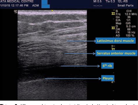 Figure 2 from Ultrasound-Guided Serratus Anterior Plane Block in Breast ...