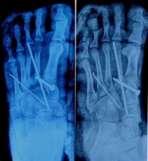 Divergent Lisfranc injury with dislocation of great toe interphalangeal ...