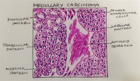 Medullary carcinoma thyroid – UG – Histopathology.guru