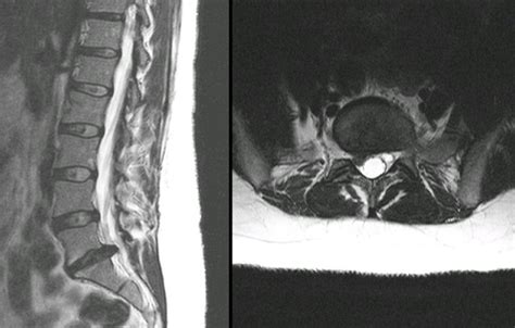 Herniated Disc Mri L5 S1 - Lumbar Herniated Disc - A More in Depth Look ...