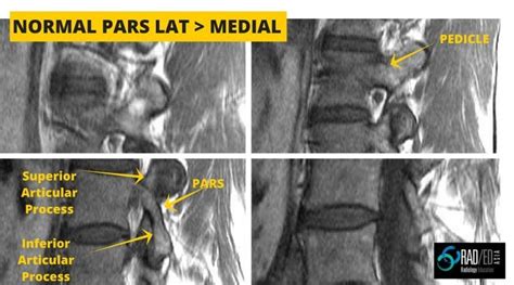 PARS DEFECTS: How to find them easily on MRI - Radedasia