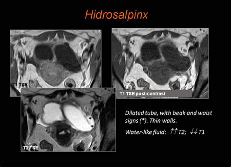 Figure 5 from MR imaging findings in Fallopian tube diseases | Semantic Scholar