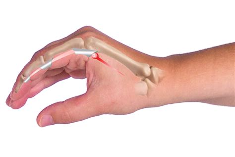 Trigger Finger Splints, Braces & Immobilizer Casts for Fractures