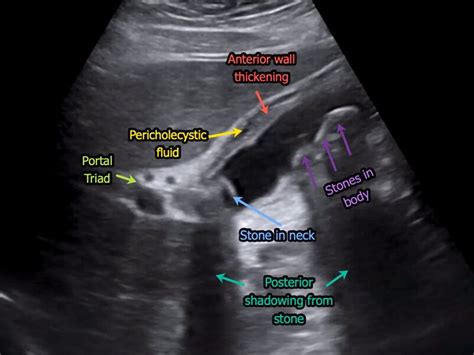 Acute Cholecystitis Ultrasound