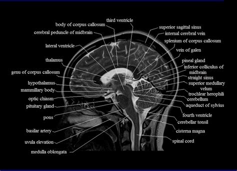 Sagittal Brain Mri