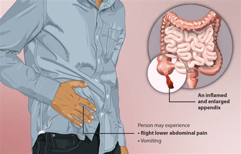 Do You Have A Malpractice Claim For A Missed Ruptured Appendix in Pennsylvania? | The Thistle ...