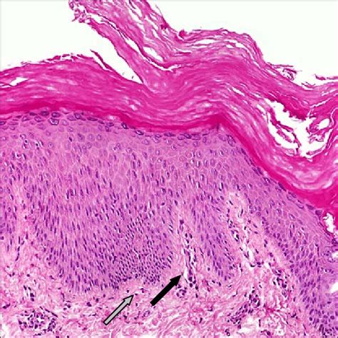 Histology of atopic dermatitis. Staining of an atopic dermatitis tissue ...