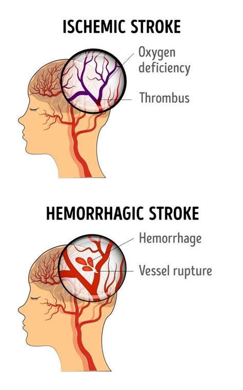 Blood Clot In Brain Stroke - Rhonda Lamb