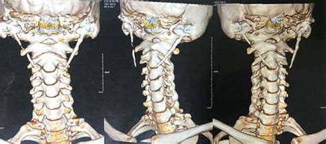 RBCP - Eagle syndrome: a case report