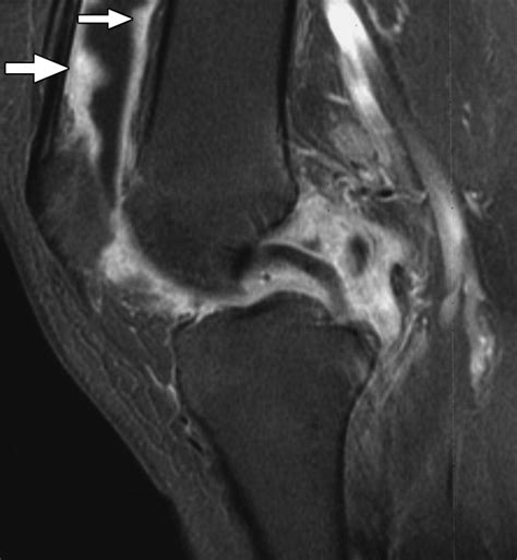 Rheumatoid Arthritis Mri