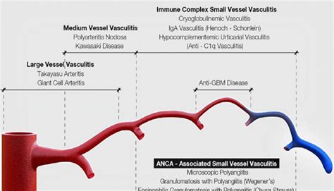 Vasculitis Diagram