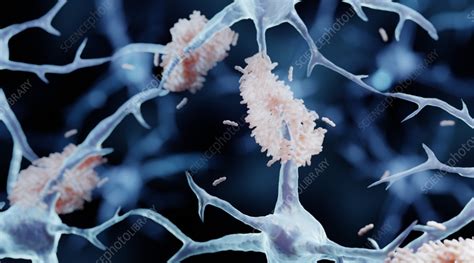 Amyloid plaque formation, illustration - Stock Image - F035/6198 ...