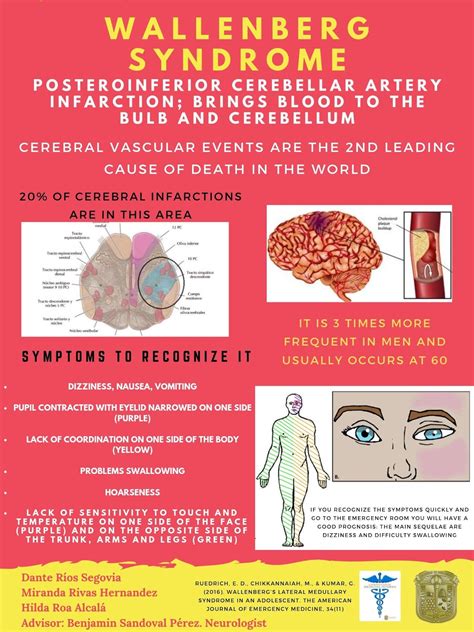 DIVULGACIÓN CIENTÍFICA UG: Wallenberg syndrome