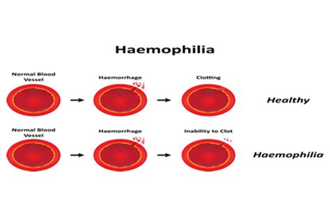 Christmas Disease (Haemophilia)