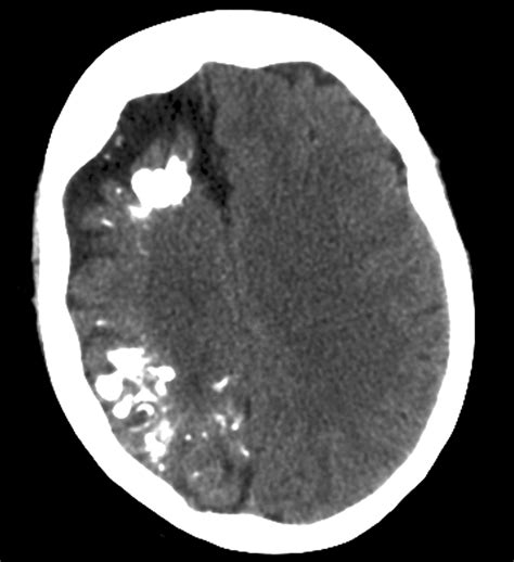 Calcification In Brain