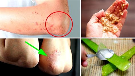 4 Home Remedies for Dry Skin, Bumps & Rash on Elbows - YouTube