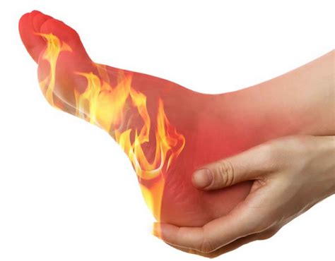 Burning feet syndrome causes, symptoms, diagnosis & treatment