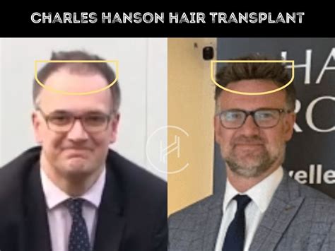 Charles Hanson Hair Transplant - Hair Loss & Technical Analysis