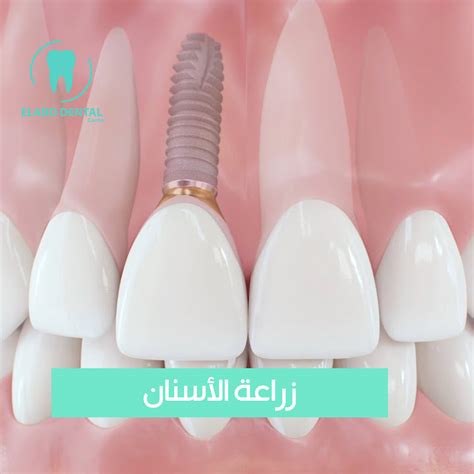 Dental implants – Al-Abd Center Clinics