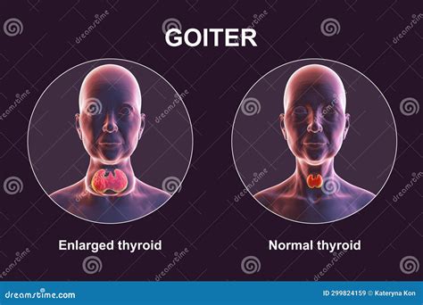 A Man With Enlarged Thyroid Gland, 3D Illustration, And Micrograph ...