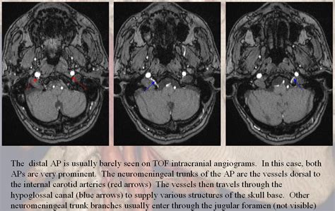 Ascending Pharyngeal Artery | neuroangio.org