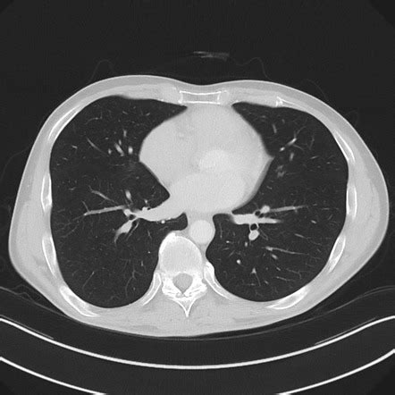 Apical pleural calcification | Image | Radiopaedia.org